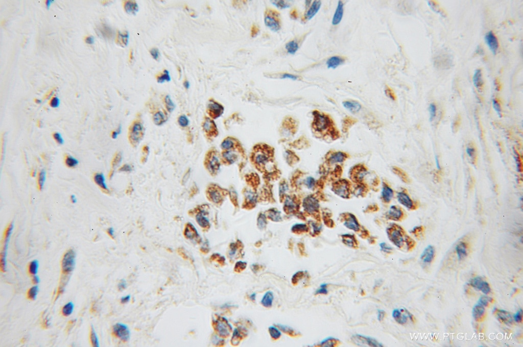 Immunohistochemistry (IHC) staining of human breast cancer tissue using CYC1 Polyclonal antibody (10242-1-AP)