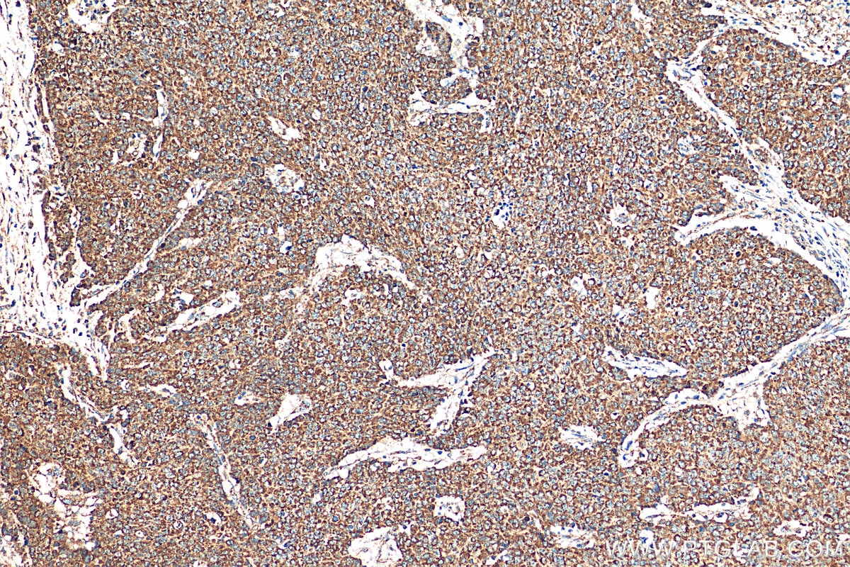 Immunohistochemistry (IHC) staining of human colon cancer tissue using Cytochrome c Polyclonal antibody (10993-1-AP)