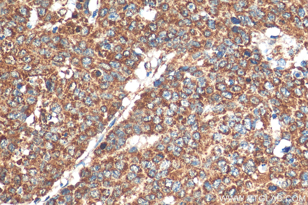 Immunohistochemistry (IHC) staining of human colon cancer tissue using Cytochrome c Polyclonal antibody (10993-1-AP)