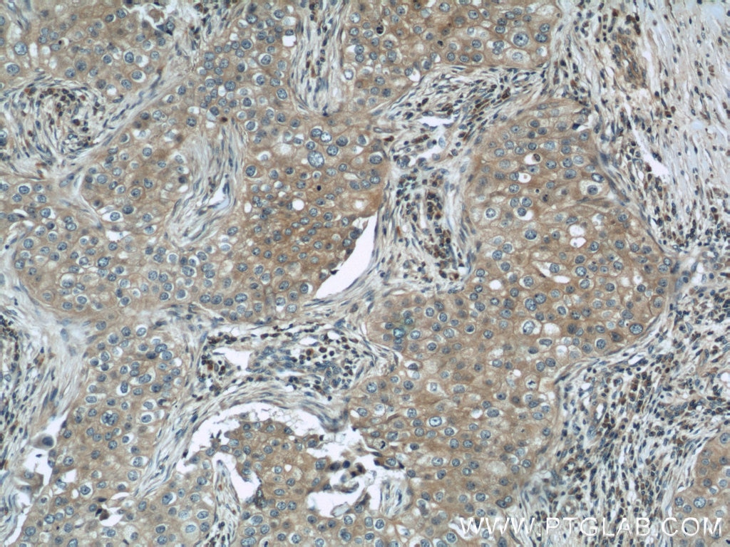 IHC staining of human breast cancer using 10993-1-AP