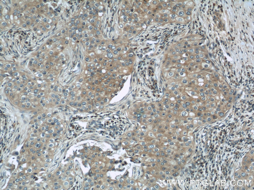 Immunohistochemistry (IHC) staining of human breast cancer tissue using Cytochrome c Polyclonal antibody (10993-1-AP)