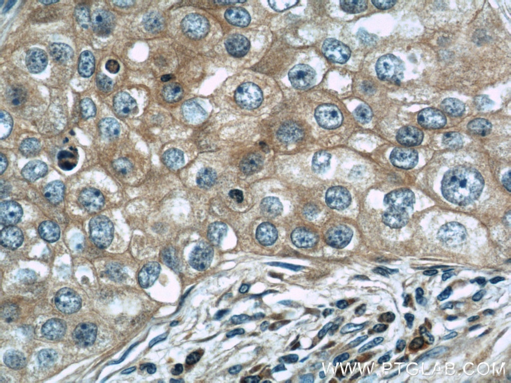 Immunohistochemistry (IHC) staining of human breast cancer tissue using Cytochrome c Polyclonal antibody (10993-1-AP)