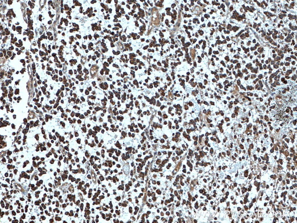 Immunohistochemistry (IHC) staining of human gliomas tissue using CYFIP1/2 Polyclonal antibody (16011-1-AP)