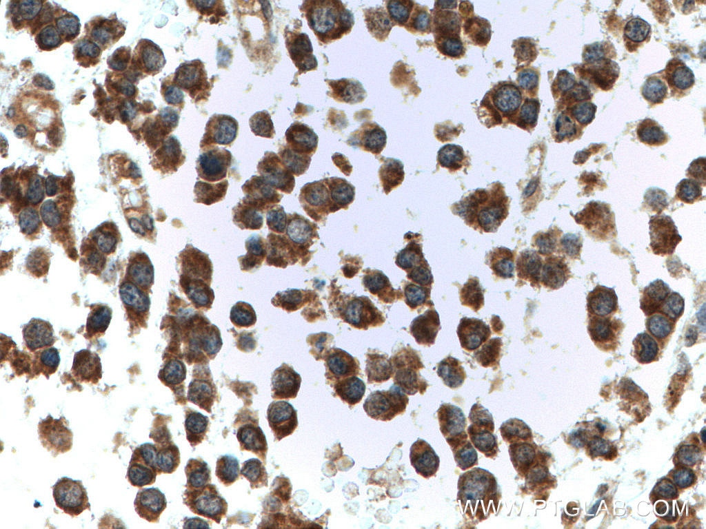 Immunohistochemistry (IHC) staining of human gliomas tissue using CYFIP1/2 Polyclonal antibody (16011-1-AP)