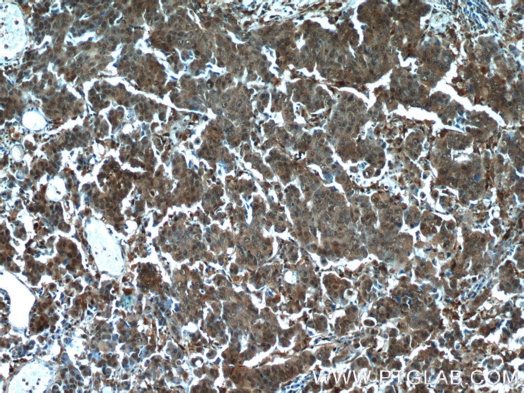 Immunohistochemistry (IHC) staining of human prostate cancer tissue using Cytoglobin Polyclonal antibody (13317-1-AP)