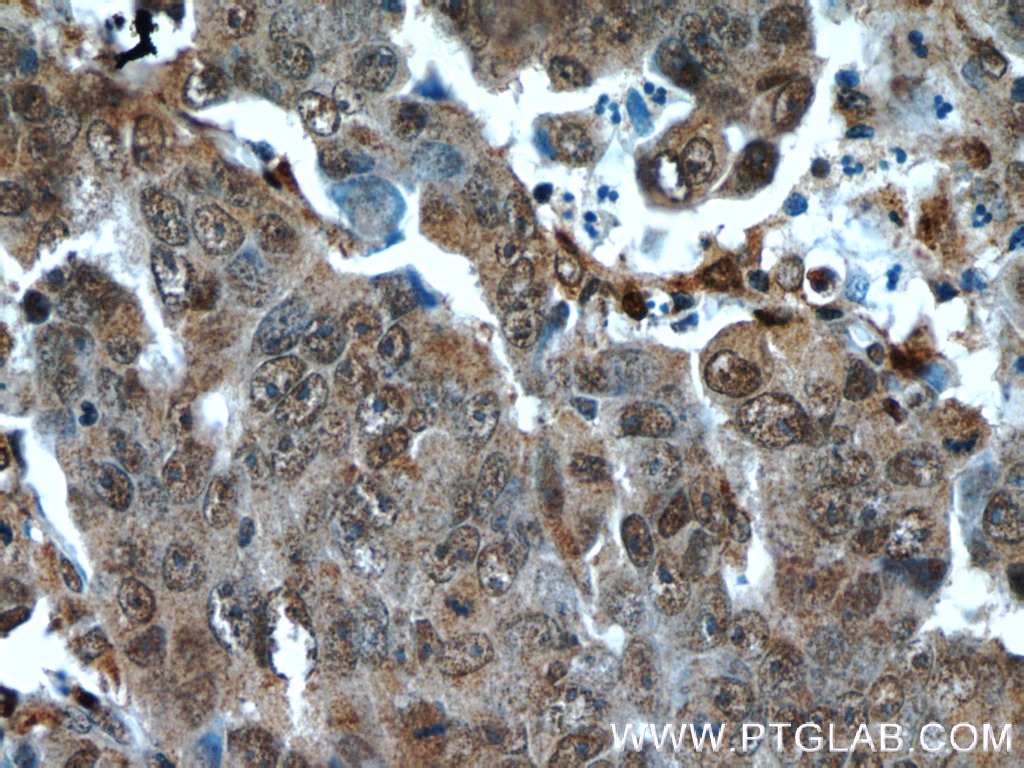 Immunohistochemistry (IHC) staining of human prostate cancer tissue using Cytoglobin Polyclonal antibody (13317-1-AP)