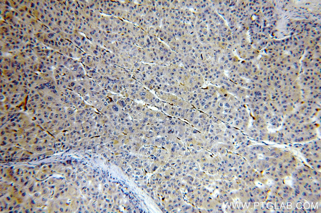 Immunohistochemistry (IHC) staining of human liver cancer tissue using Cytoglobin Polyclonal antibody (13317-1-AP)