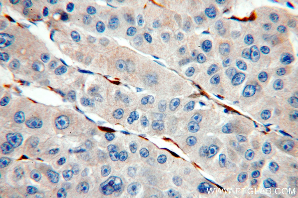 Immunohistochemistry (IHC) staining of human liver cancer tissue using Cytoglobin Polyclonal antibody (13317-1-AP)