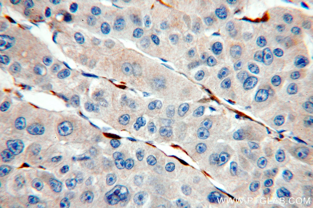 IHC staining of human liver cancer using 13317-1-AP