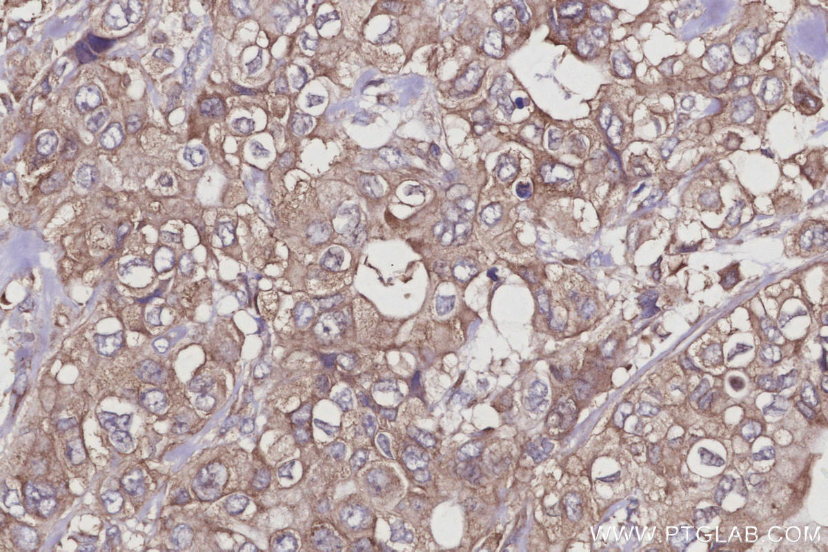 Immunohistochemistry (IHC) staining of human pancreas cancer tissue using CYLD Polyclonal antibody (11110-1-AP)