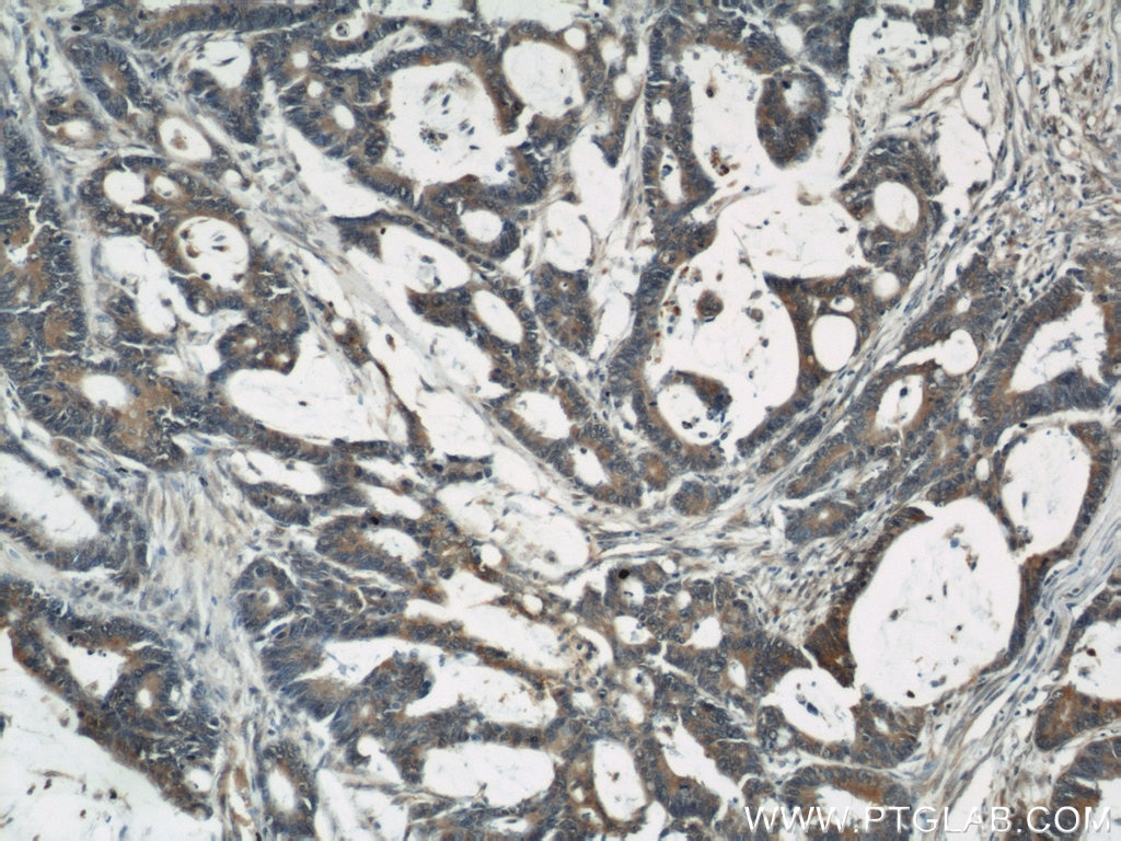 Immunohistochemistry (IHC) staining of human colon cancer tissue using CYLD Polyclonal antibody (11110-1-AP)