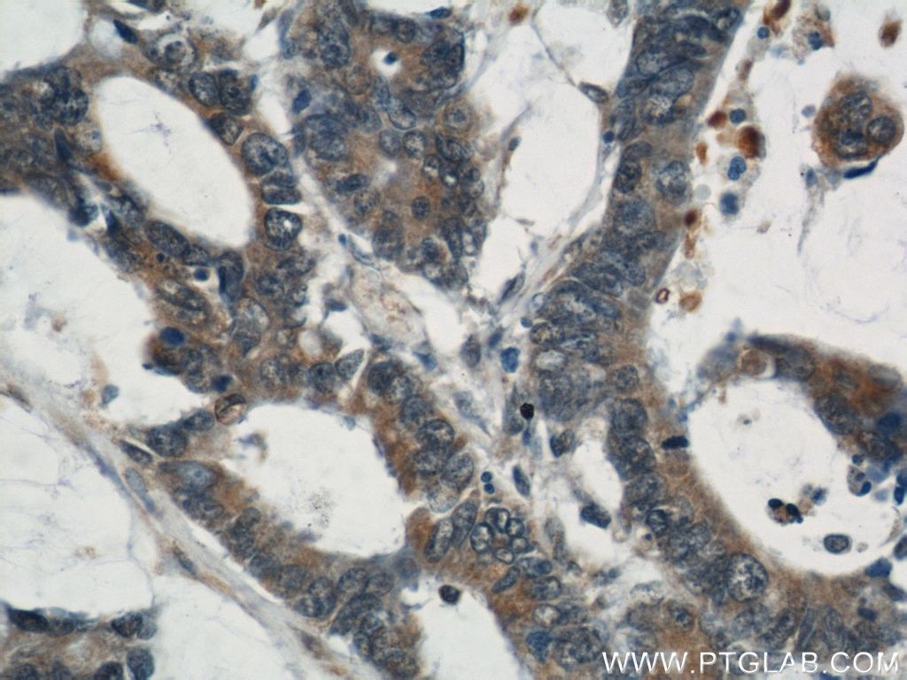 Immunohistochemistry (IHC) staining of human colon cancer tissue using CYLD Polyclonal antibody (11110-1-AP)