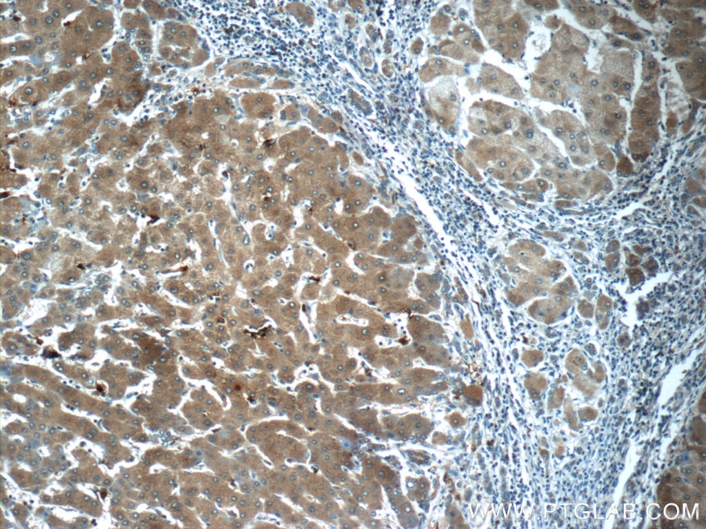 Immunohistochemistry (IHC) staining of human hepatocirrhosis tissue using CYP11B2 Polyclonal antibody (20968-1-AP)
