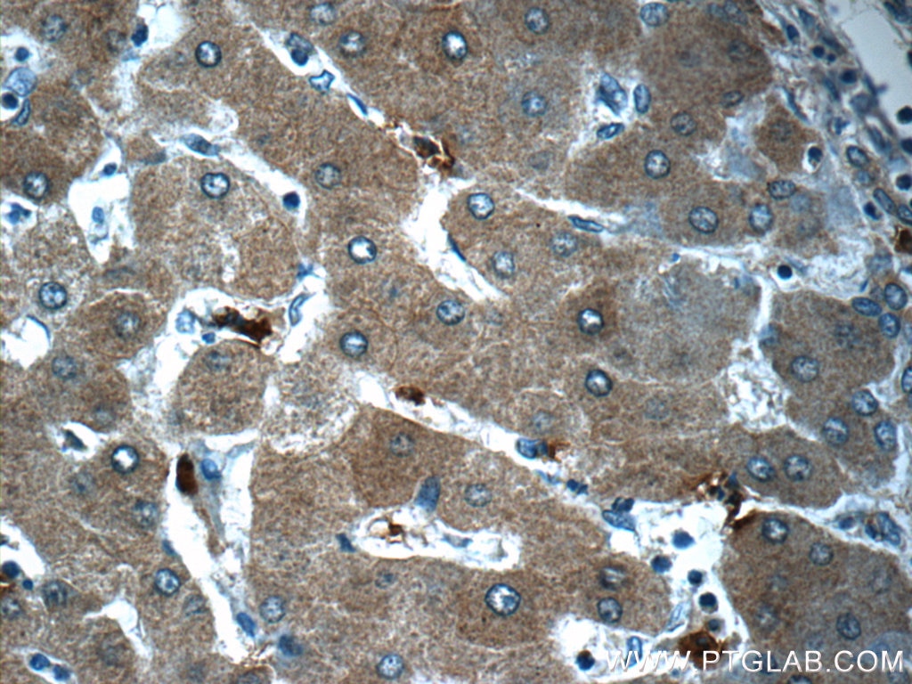 Immunohistochemistry (IHC) staining of human hepatocirrhosis tissue using CYP11B2 Polyclonal antibody (20968-1-AP)