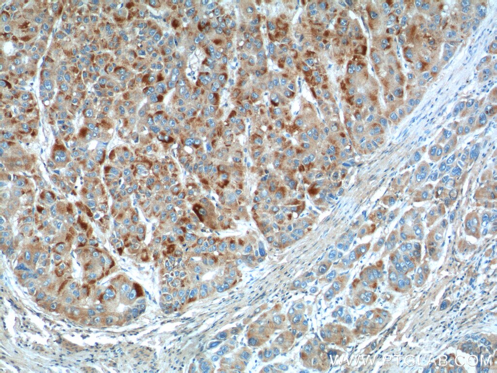 Immunohistochemistry (IHC) staining of human liver cancer tissue using CYP11B2 Polyclonal antibody (20968-1-AP)