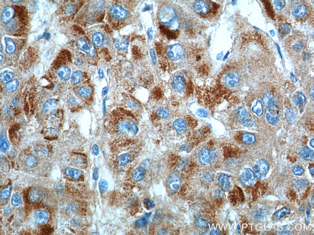 IHC staining of human liver cancer using 20968-1-AP