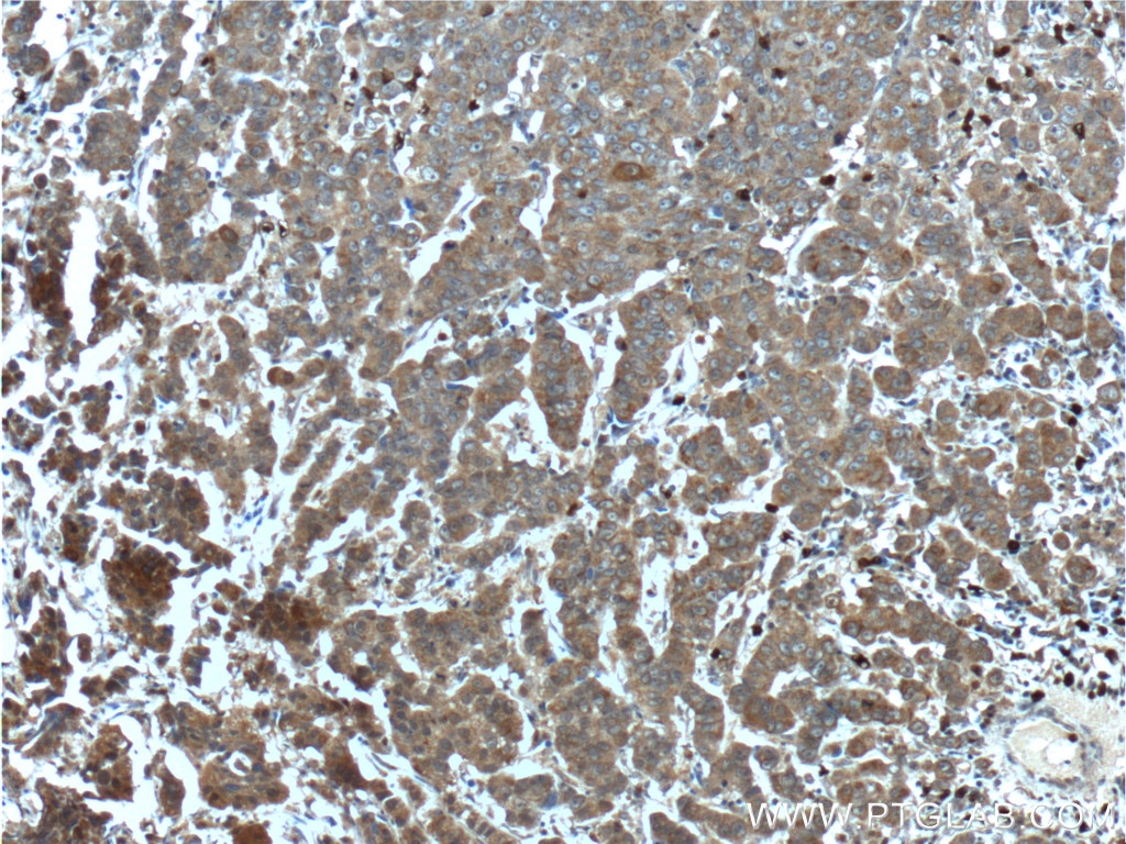 Immunohistochemistry (IHC) staining of human prostate cancer tissue using CYP17A1 Polyclonal antibody (14447-1-AP)