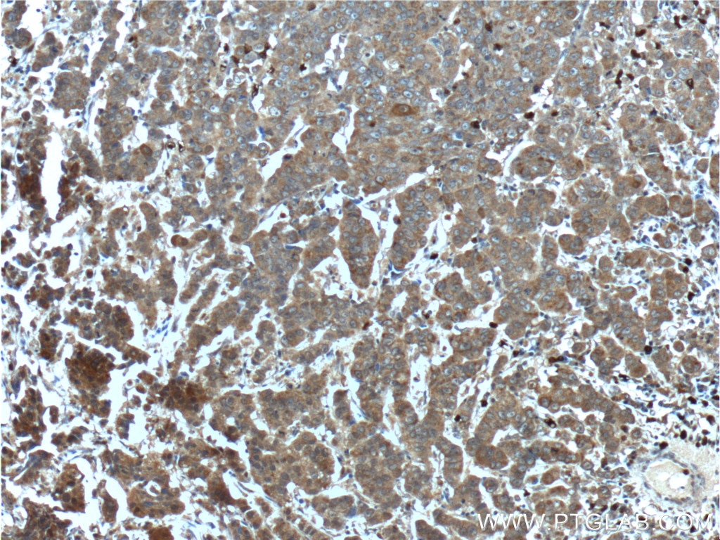 Immunohistochemistry (IHC) staining of human prostate cancer tissue using CYP17A1 Polyclonal antibody (14447-1-AP)