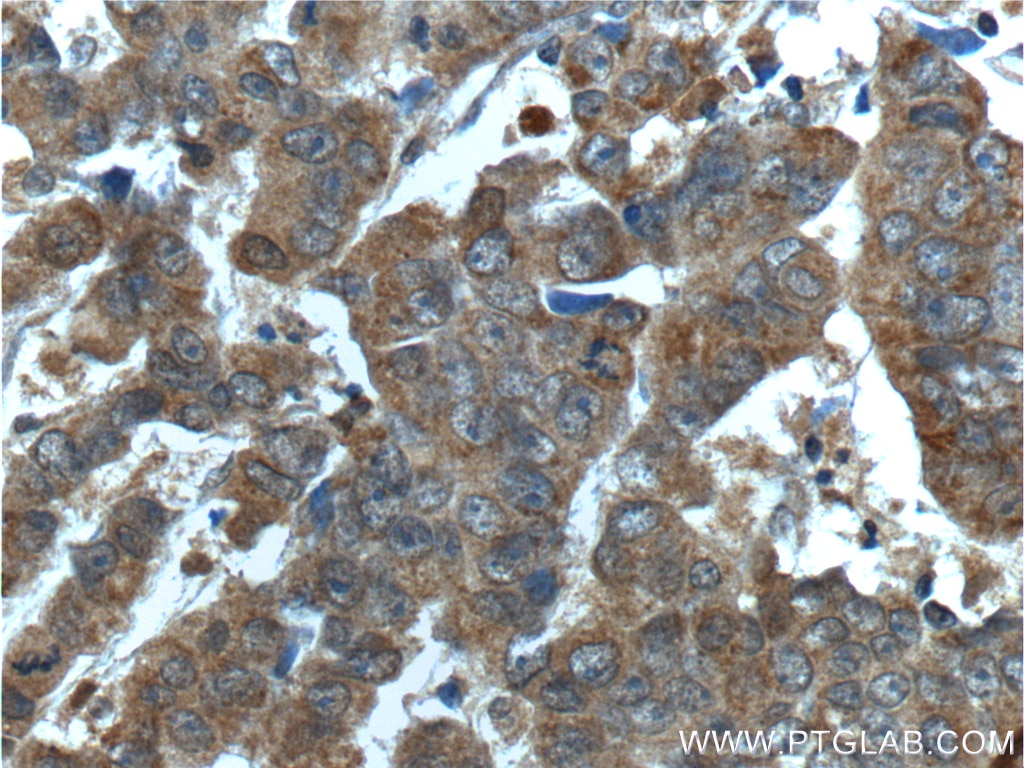 Immunohistochemistry (IHC) staining of human prostate cancer tissue using CYP17A1 Polyclonal antibody (14447-1-AP)