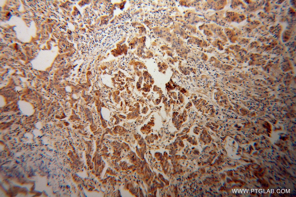 IHC staining of human prostate cancer using 14447-1-AP