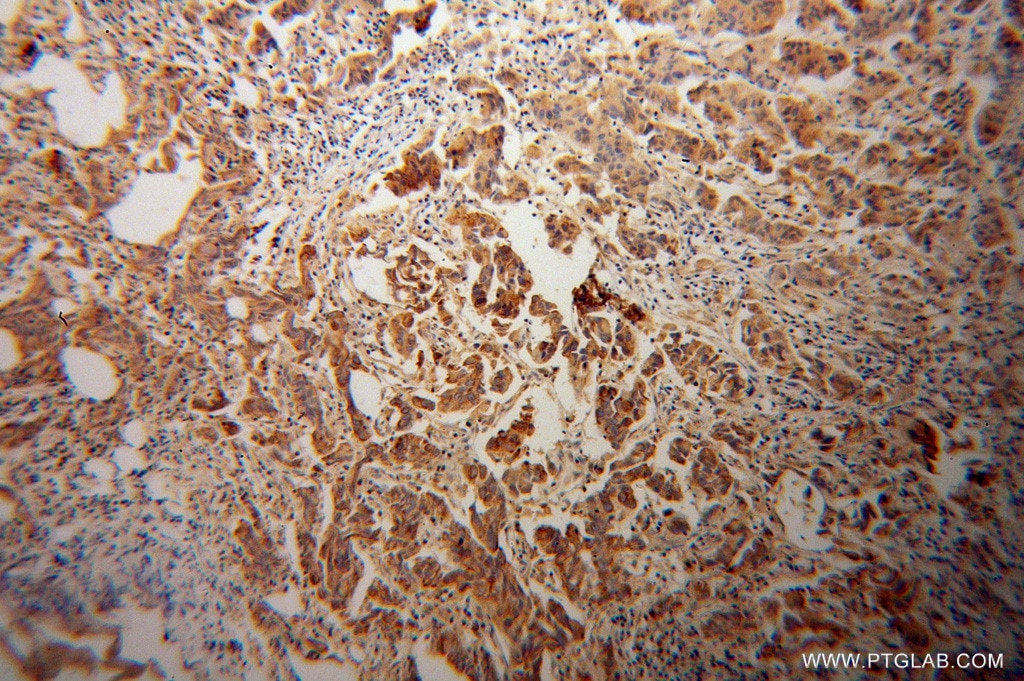 Immunohistochemistry (IHC) staining of human prostate cancer tissue using CYP17A1 Polyclonal antibody (14447-1-AP)