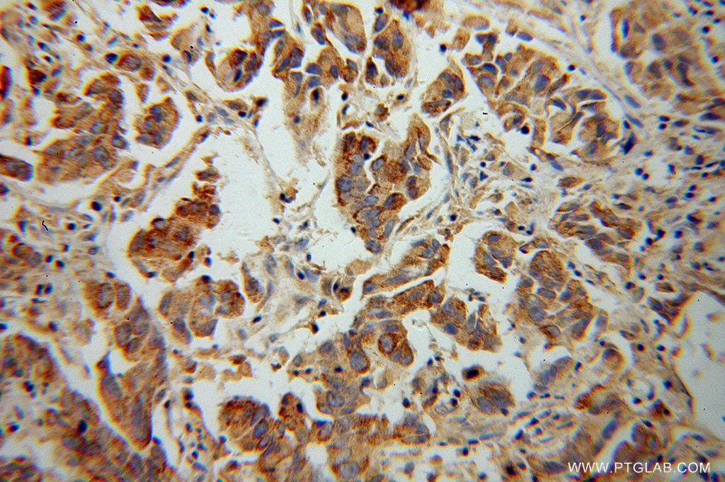 Immunohistochemistry (IHC) staining of human prostate cancer tissue using CYP17A1 Polyclonal antibody (14447-1-AP)
