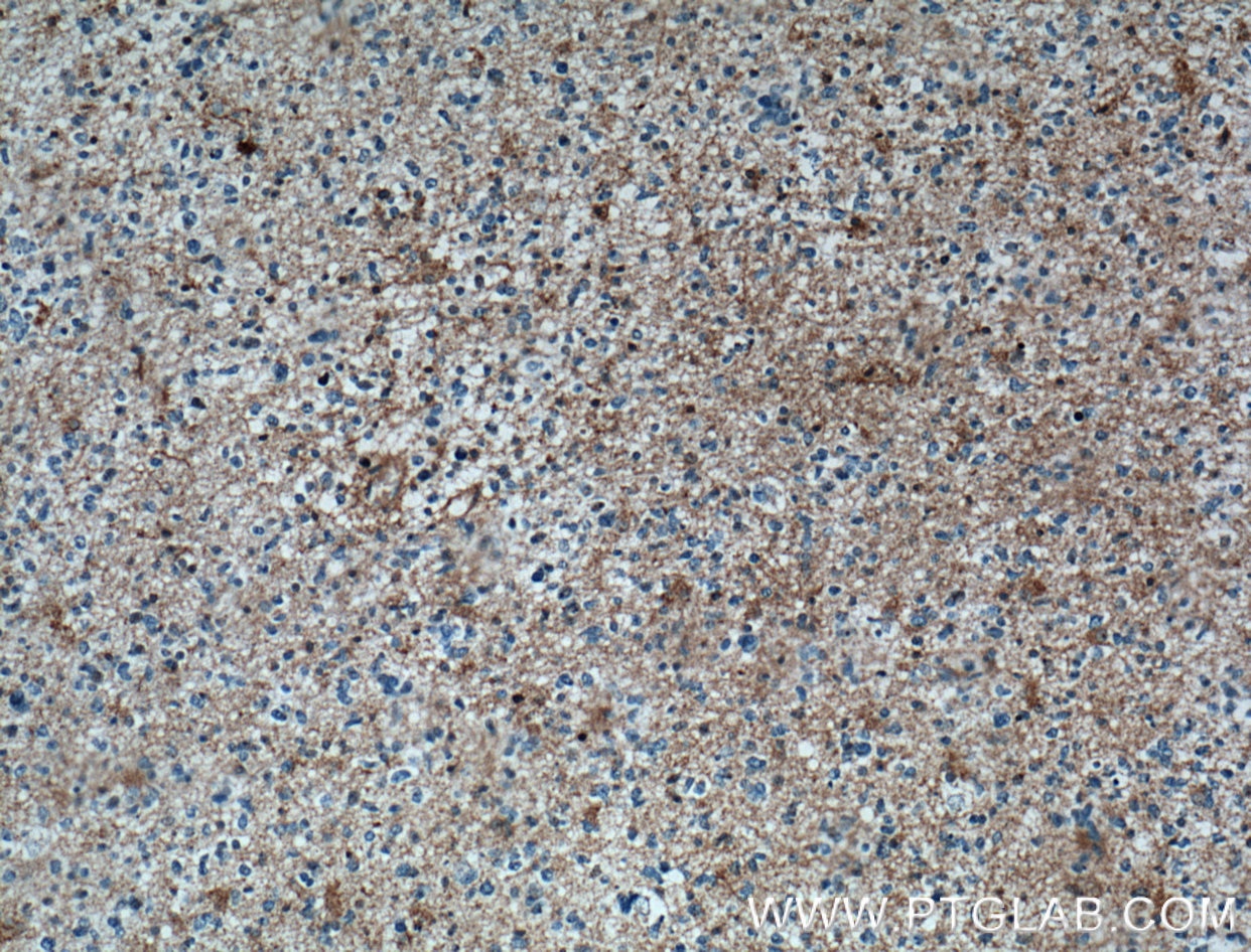 Immunohistochemistry (IHC) staining of human gliomas tissue using CYP19A1 Polyclonal antibody (16554-1-AP)