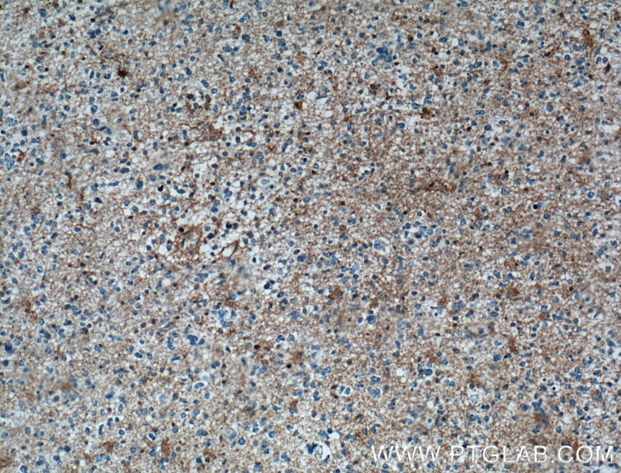 IHC staining of human gliomas using 16554-1-AP