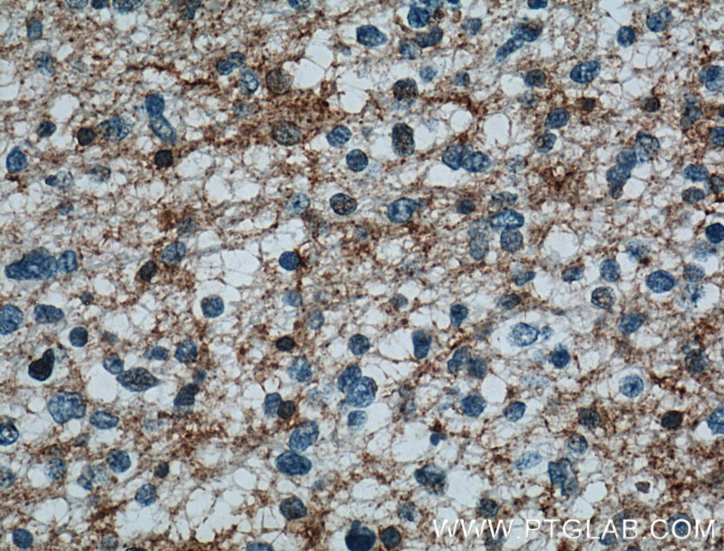 IHC staining of human gliomas using 16554-1-AP