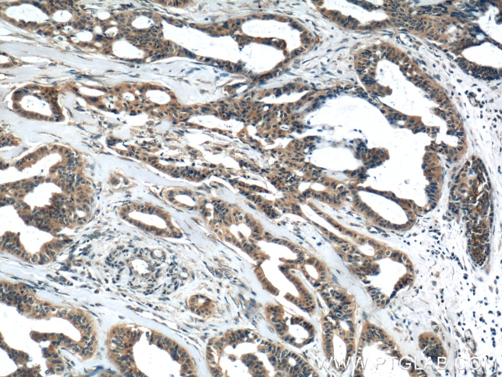 Immunohistochemistry (IHC) staining of human breast cancer tissue using CYP1A1 Polyclonal antibody (13241-1-AP)