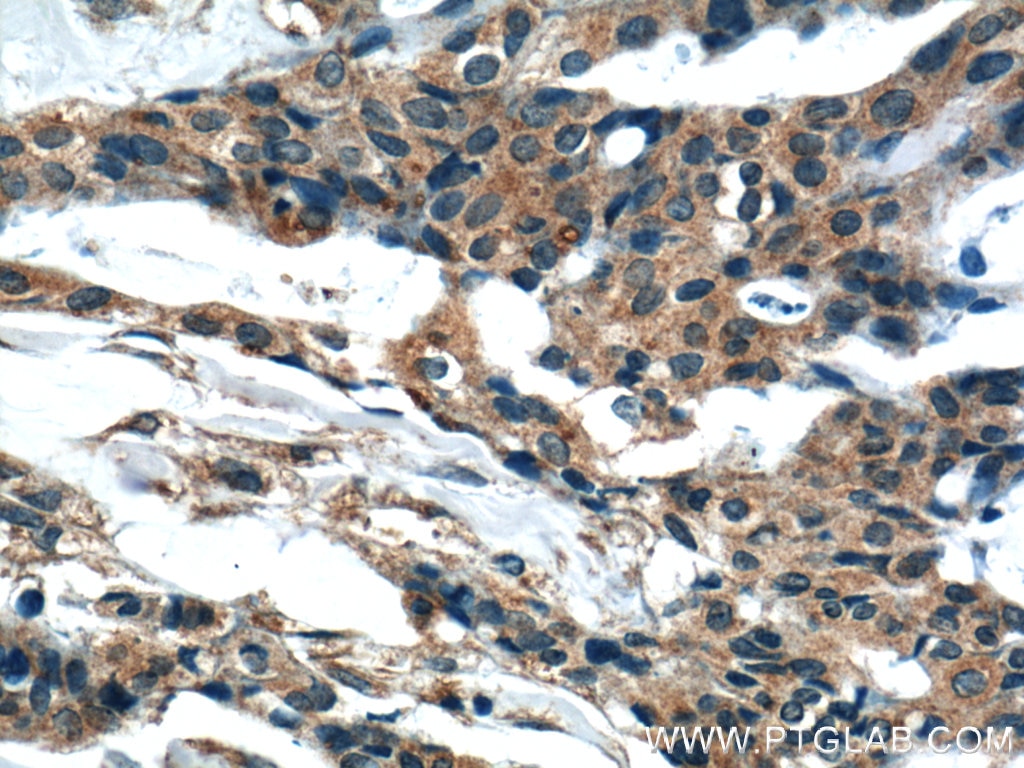 Immunohistochemistry (IHC) staining of human breast cancer tissue using CYP1A1 Polyclonal antibody (13241-1-AP)