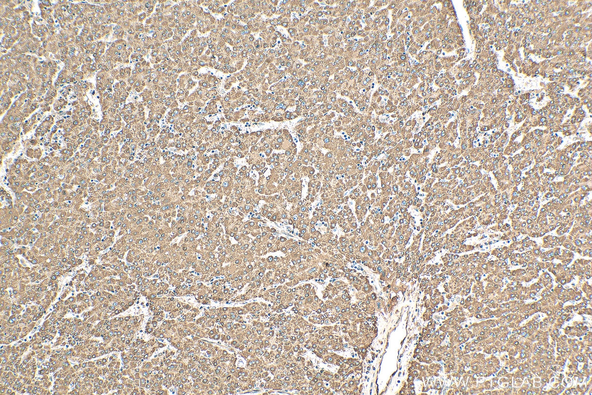 Immunohistochemistry (IHC) staining of human liver cancer tissue using CYP1A1 Polyclonal antibody (13241-1-AP)