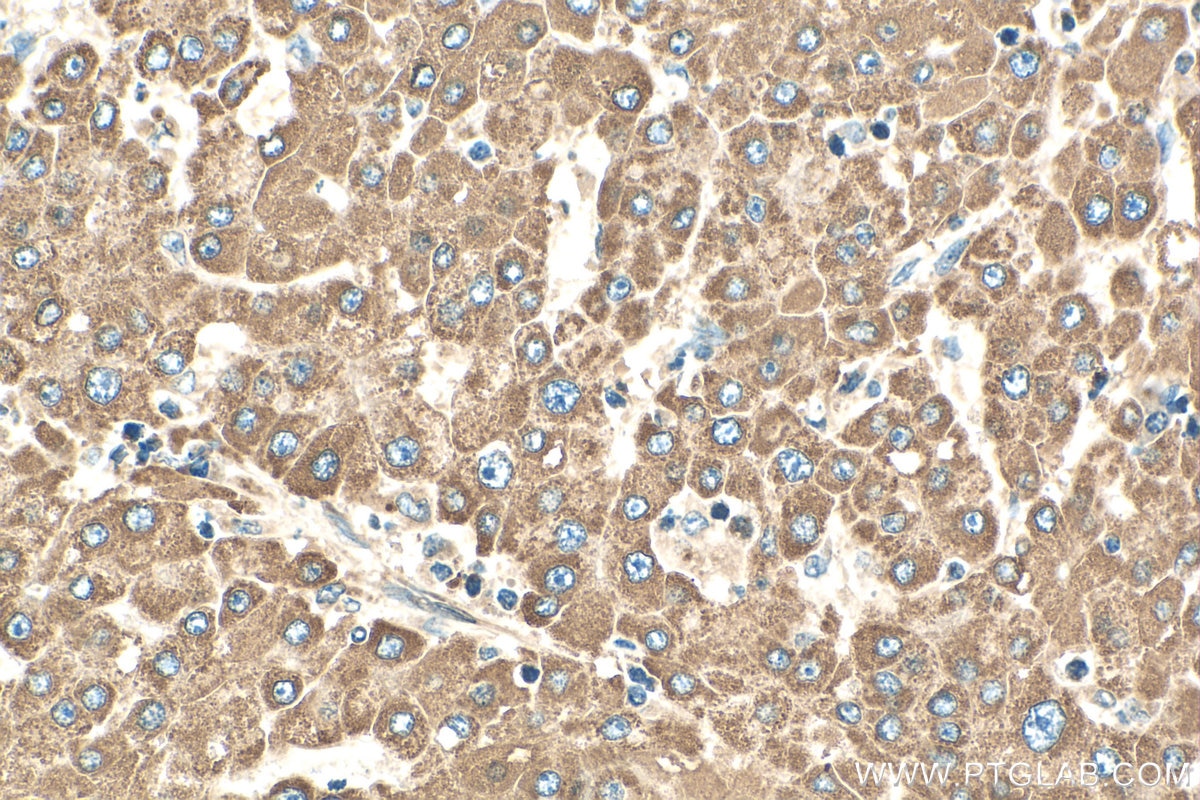 Immunohistochemistry (IHC) staining of human liver cancer tissue using CYP1A1 Polyclonal antibody (13241-1-AP)