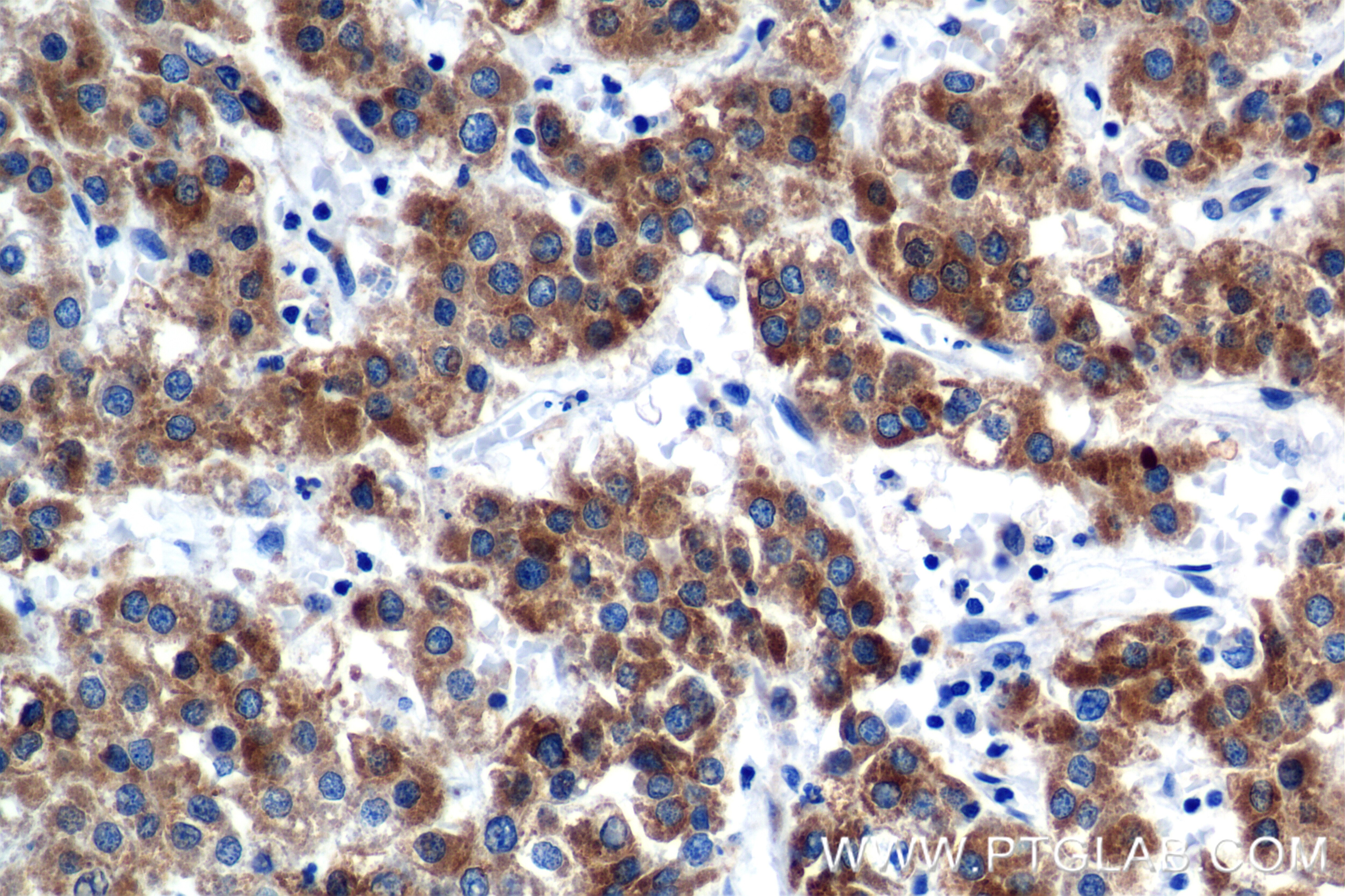 Immunohistochemical analysis of paraffin-embedded Human Hepatocellular cancer slide using 84751-1-RR (CYP1A2-Specific antibody) at dilution of 1:400 (under 40x lens). Heat mediated antigen retrieval with Tris-EDTA buffer (pH 9.0). Immunohistochemistry (IHC) staining of Human Hepatocellular cancer using CYP1A2-Specific Recombinant monoclonal antibody (84751-1-RR)