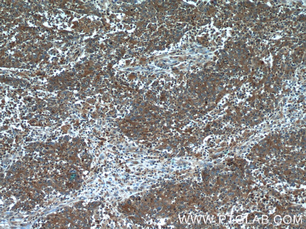 Immunohistochemistry (IHC) staining of human colon cancer tissue using CYP1B1 Polyclonal antibody (18505-1-AP)