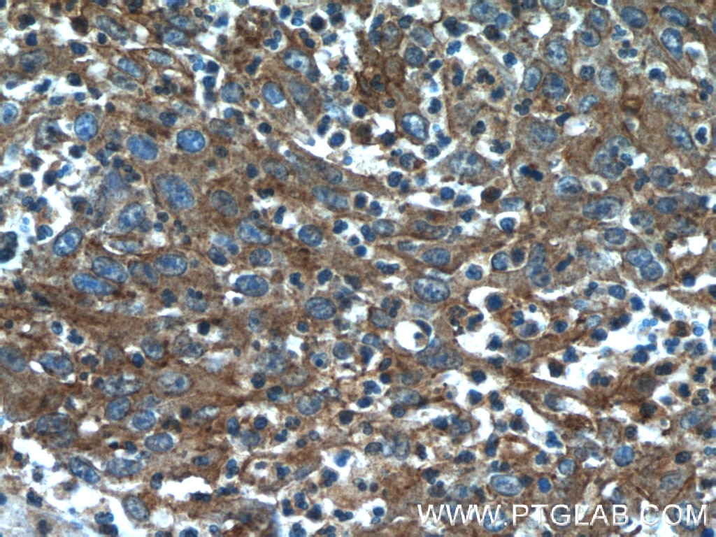 Immunohistochemistry (IHC) staining of human colon cancer tissue using CYP1B1 Polyclonal antibody (18505-1-AP)