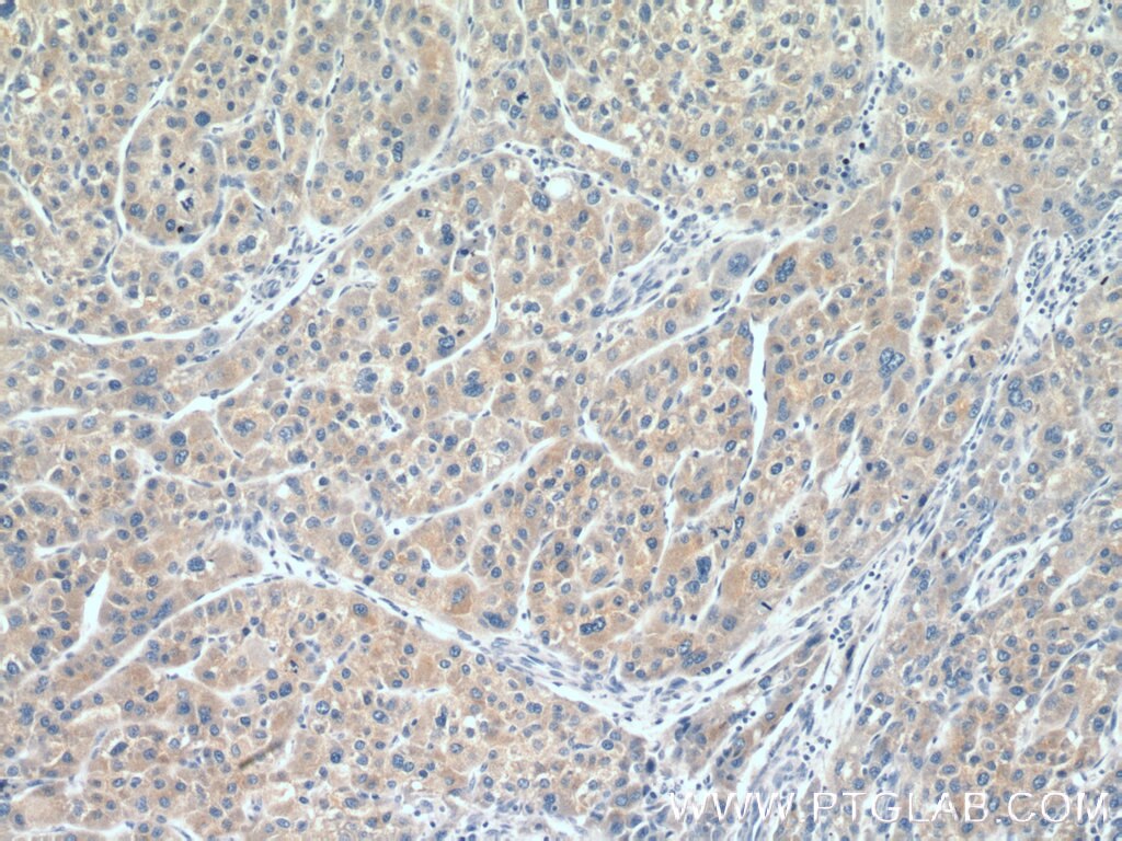 IHC staining of human liver cancer using 16702-1-AP