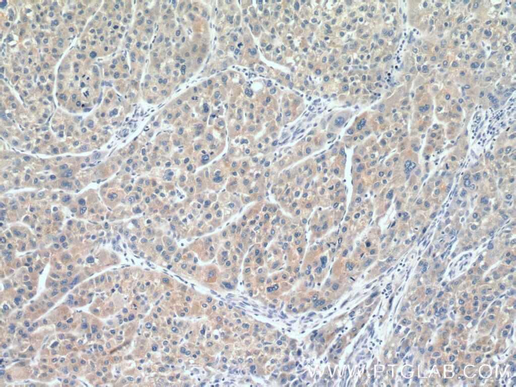 Immunohistochemistry (IHC) staining of human liver cancer tissue using CYP20A1 Polyclonal antibody (16702-1-AP)