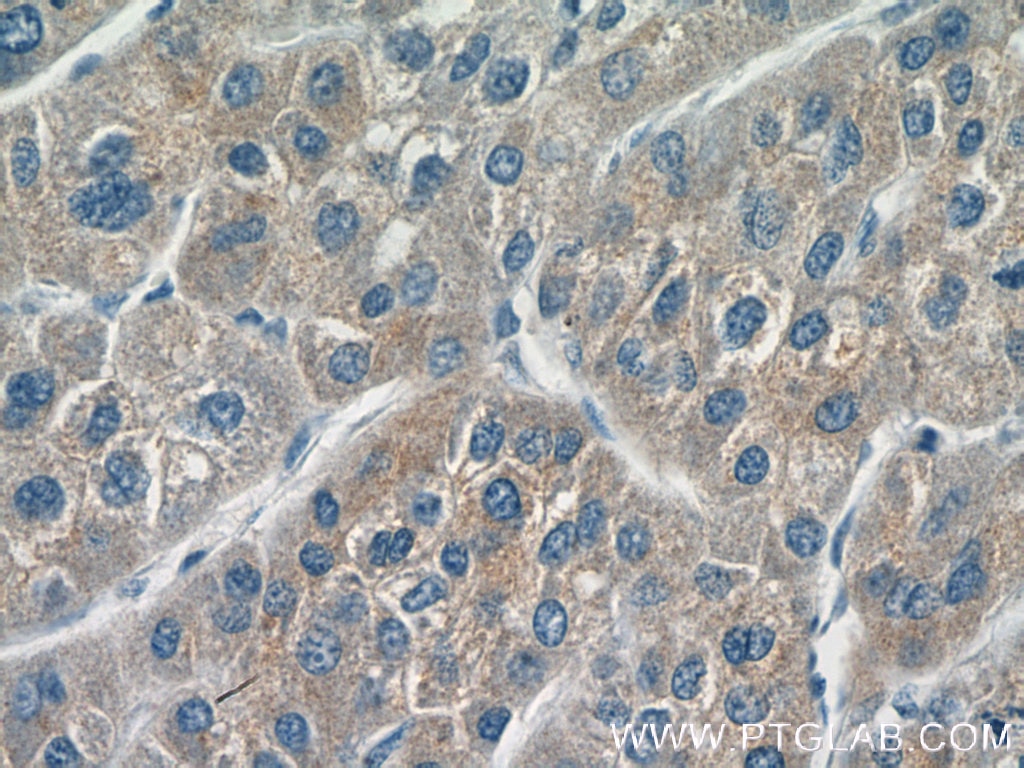 Immunohistochemistry (IHC) staining of human liver cancer tissue using CYP20A1 Polyclonal antibody (16702-1-AP)