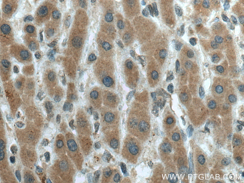Immunohistochemistry (IHC) staining of human liver cancer tissue using CYP20A1 Monoclonal antibody (67433-1-Ig)
