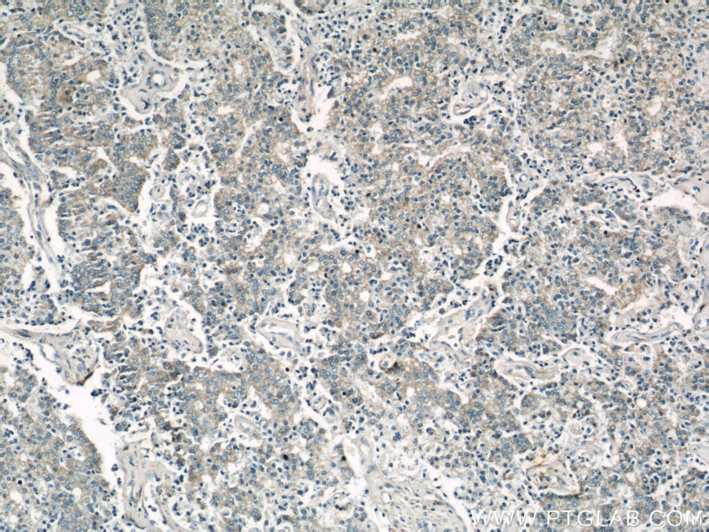 Immunohistochemistry (IHC) staining of human prostate cancer tissue using CYP24A1 Polyclonal antibody (21582-1-AP)