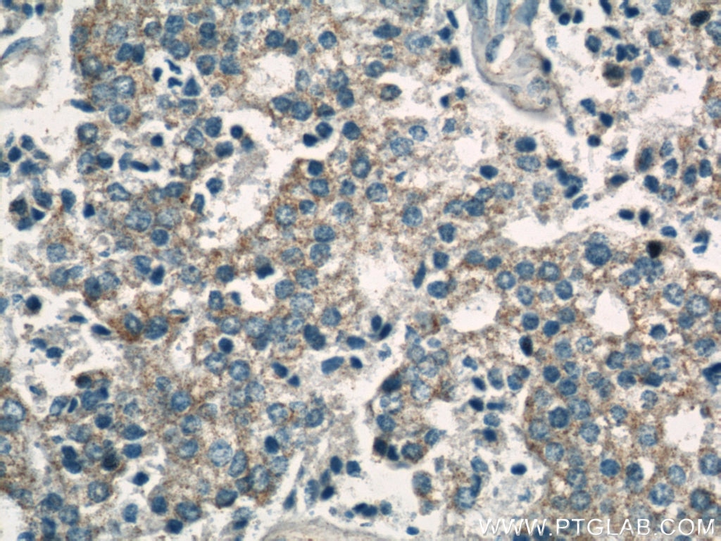 Immunohistochemistry (IHC) staining of human prostate cancer tissue using CYP24A1 Polyclonal antibody (21582-1-AP)