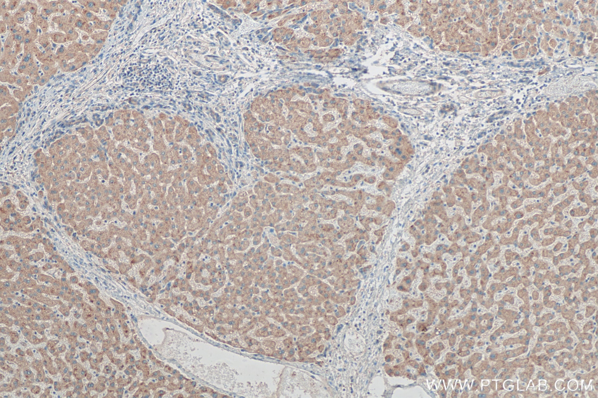 Immunohistochemistry (IHC) staining of human hepatocirrhosis tissue using CYP26B1 Polyclonal antibody (21555-1-AP)