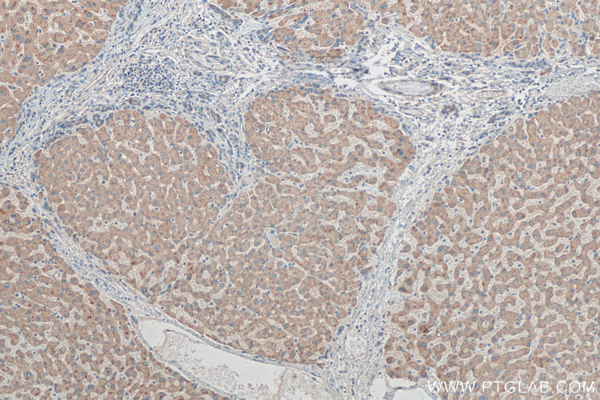 IHC staining of human hepatocirrhosis using 21555-1-AP