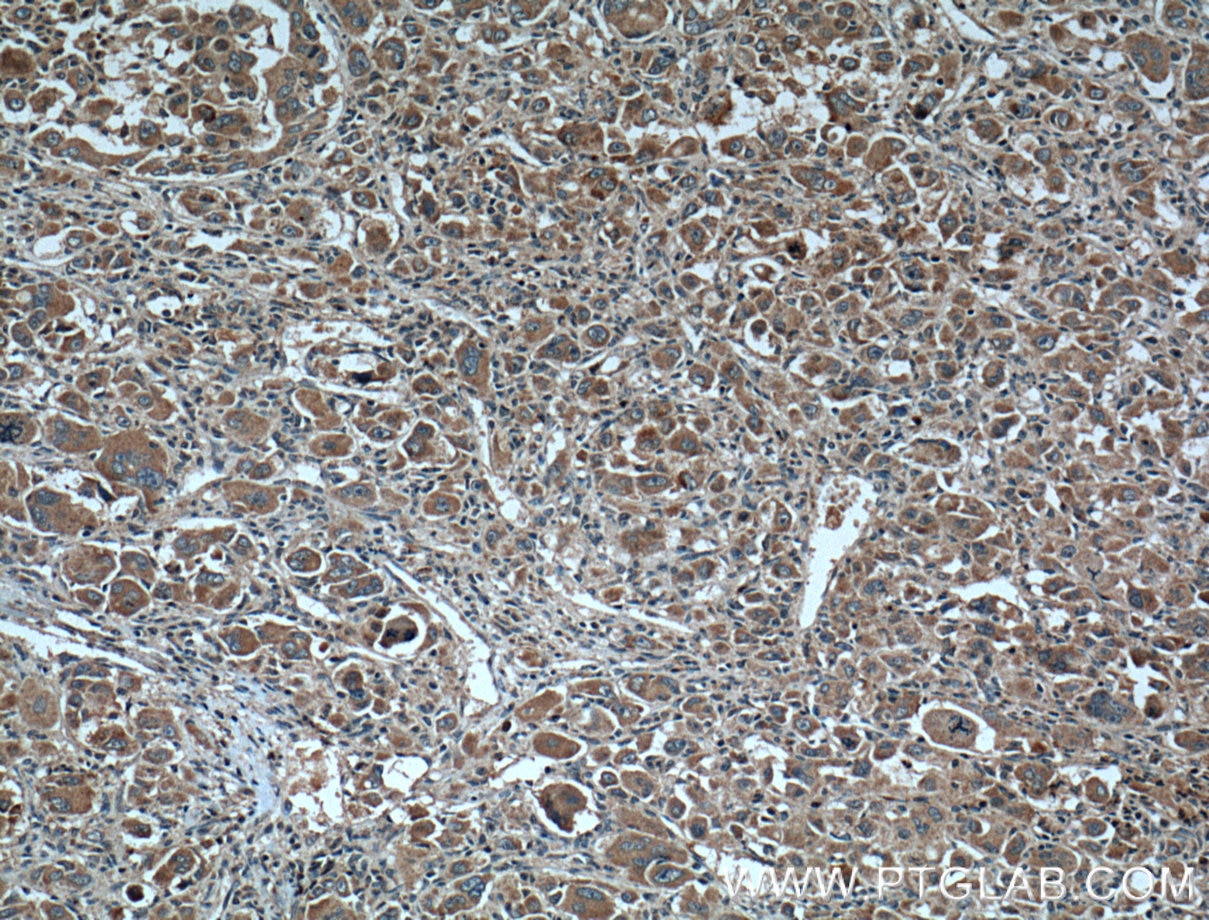 Immunohistochemistry (IHC) staining of human liver cancer tissue using CYP27A1 Polyclonal antibody (14739-1-AP)