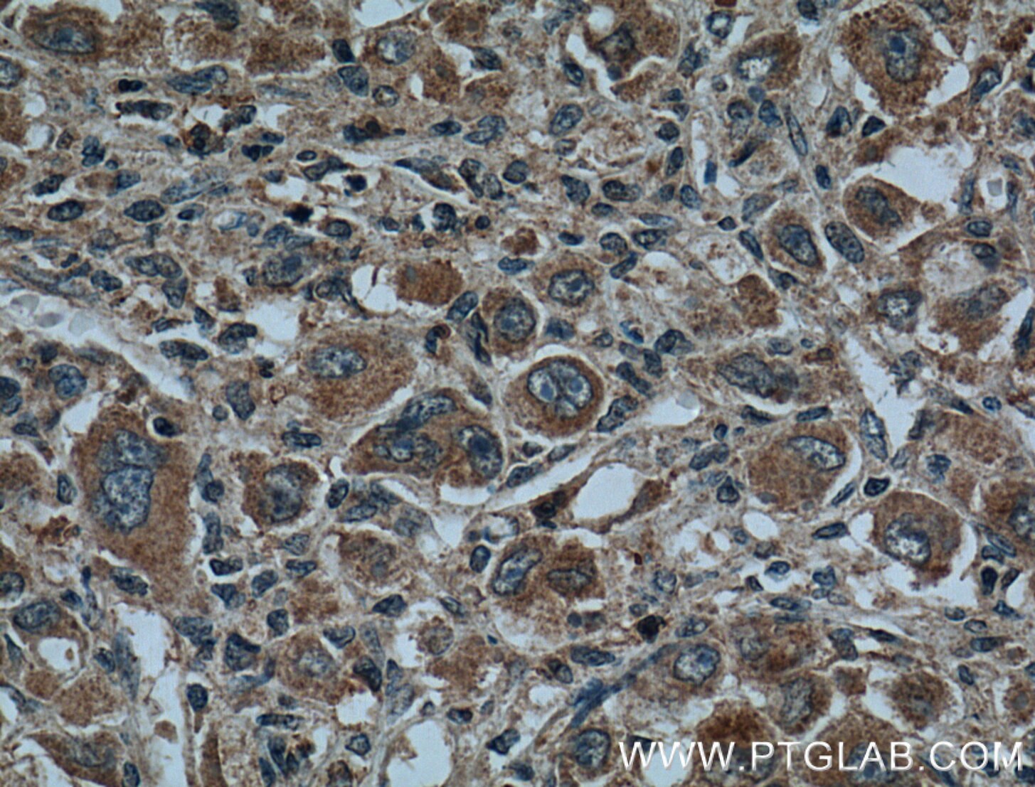 Immunohistochemistry (IHC) staining of human liver cancer tissue using CYP27A1 Polyclonal antibody (14739-1-AP)