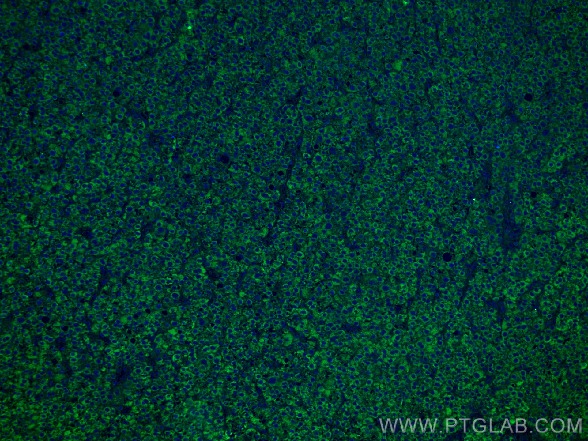 Immunofluorescence (IF) / fluorescent staining of human liver cancer tissue using CYP27A1 Monoclonal antibody (67045-1-Ig)