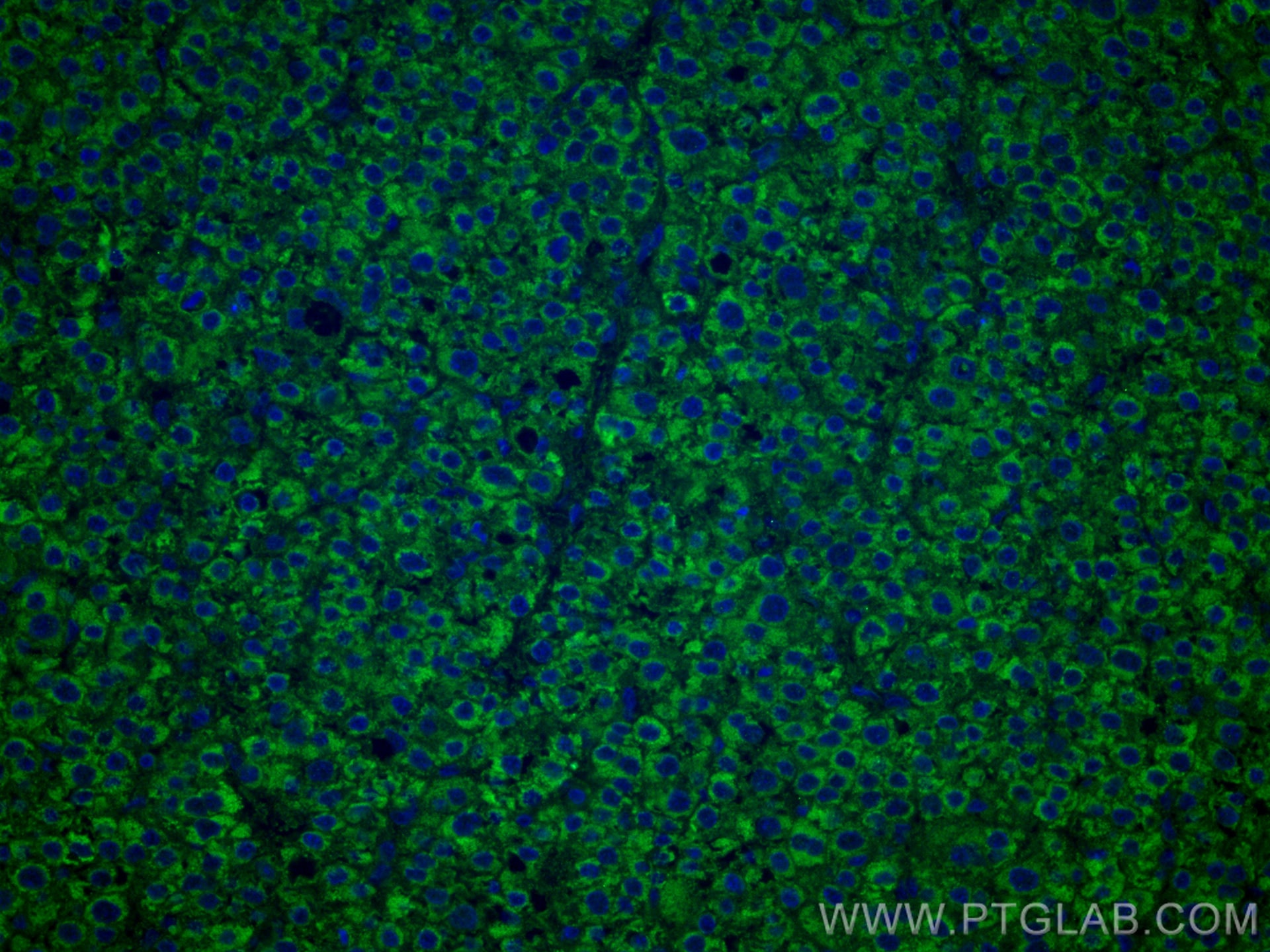 IF Staining of human liver cancer using 67045-1-Ig