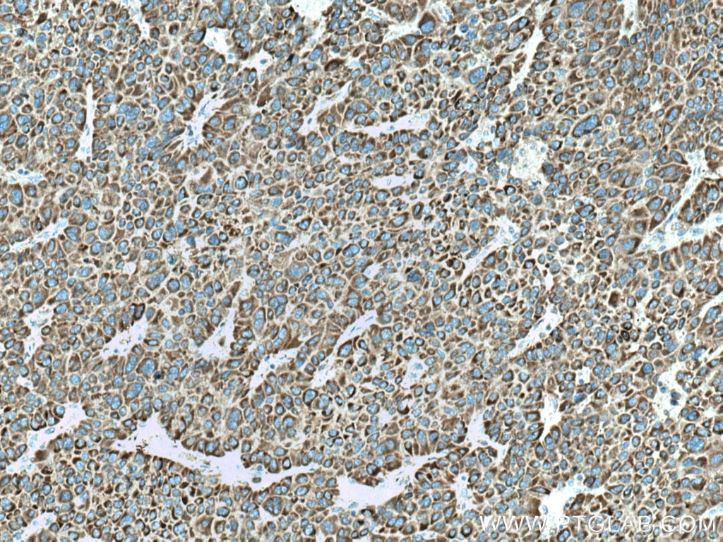 Immunohistochemistry (IHC) staining of human liver cancer tissue using CYP27A1 Monoclonal antibody (67045-1-Ig)