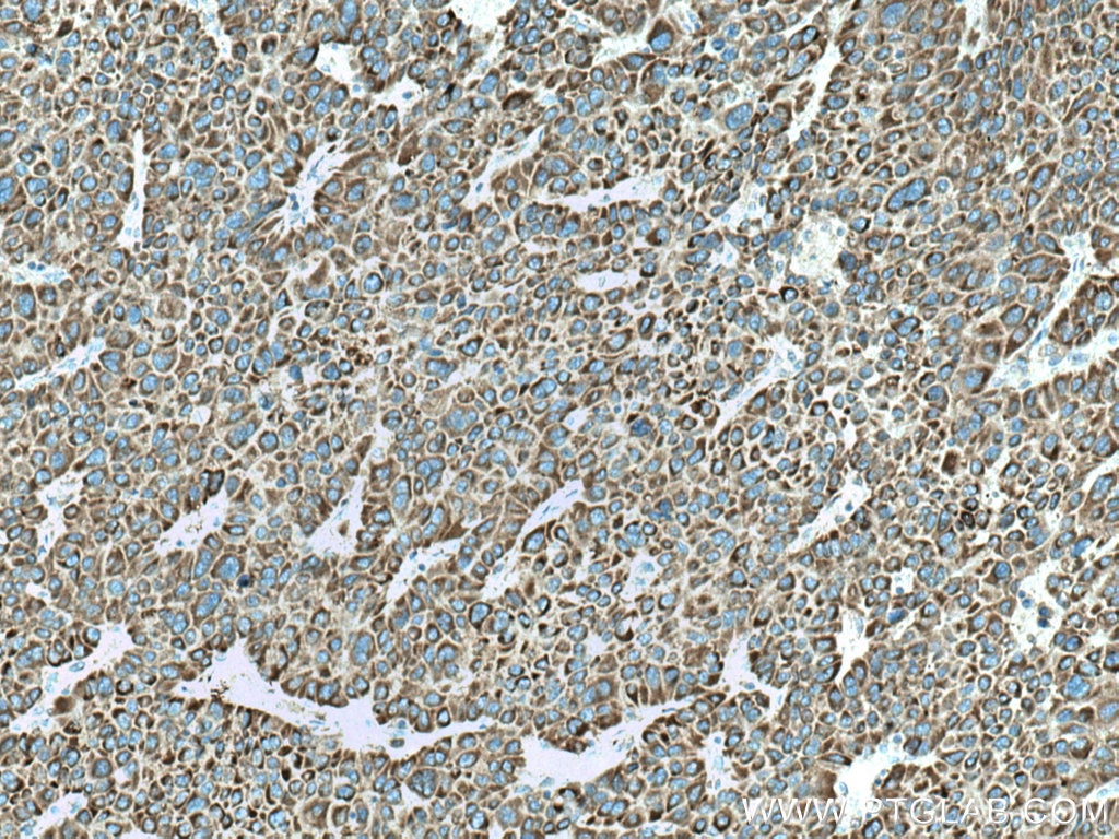 IHC staining of human liver cancer using 67045-1-Ig